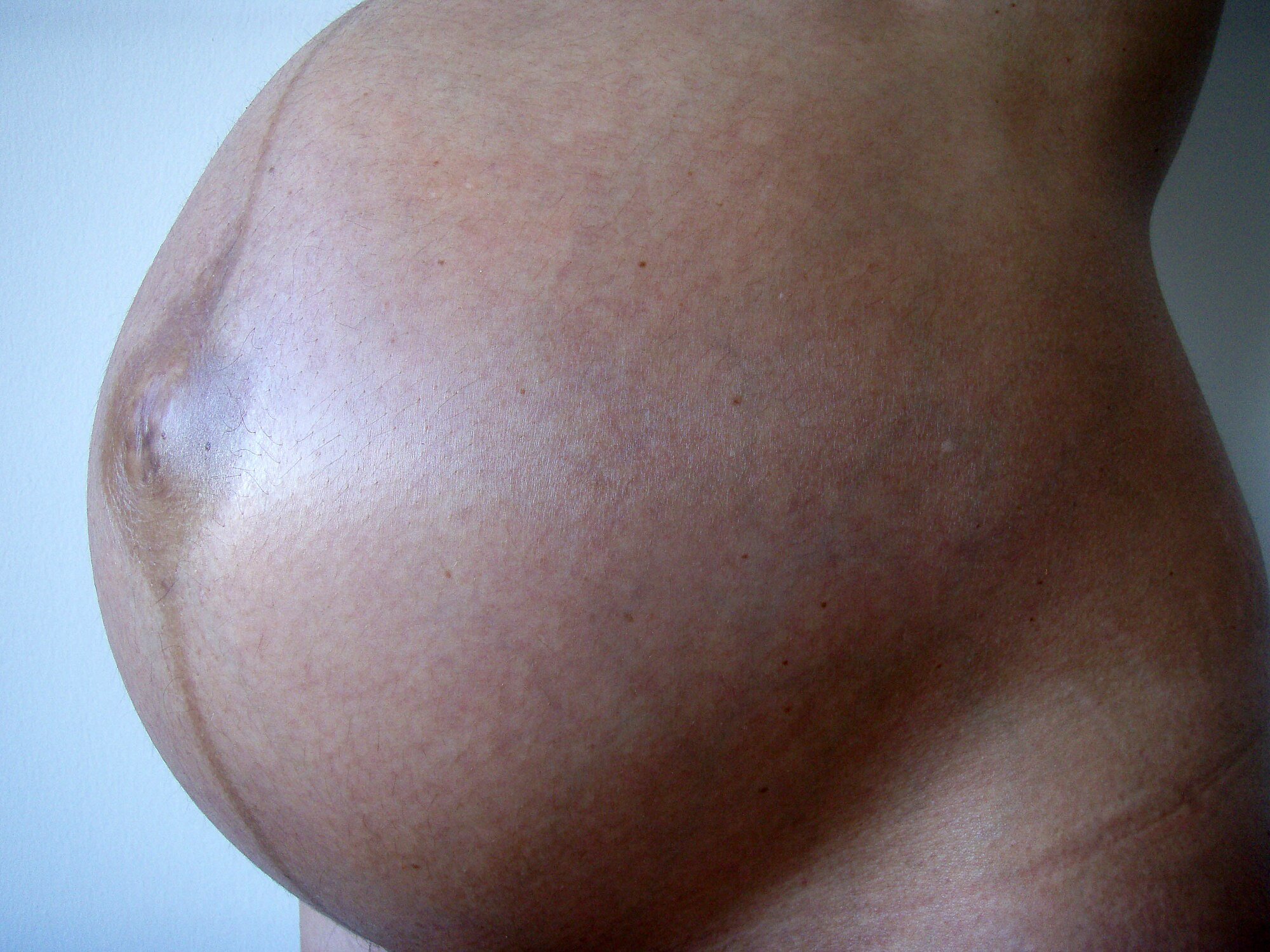 File:2008-02-24 Human abdomen in pregnancy.jpg